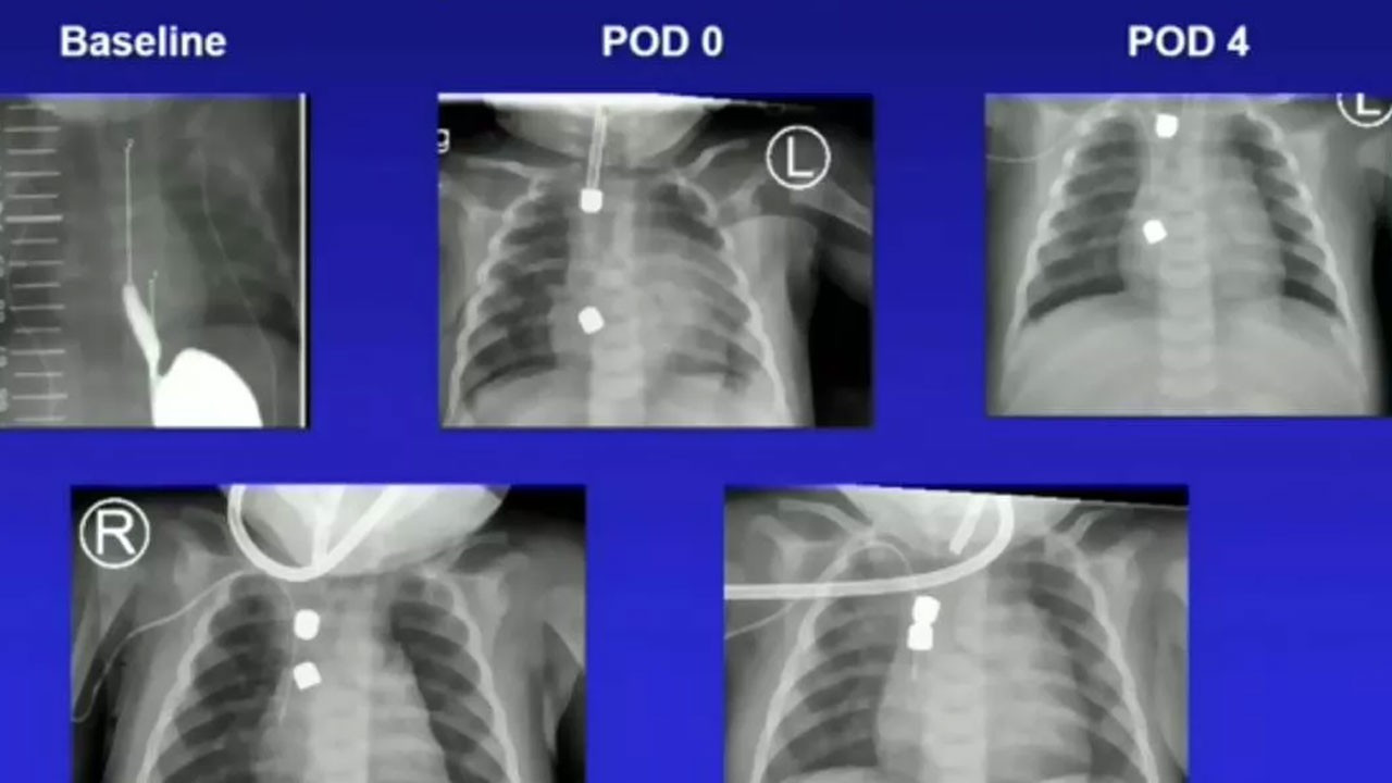 Kanada'da ilk kez bir bebeğin yemek borusu mıknatısla tutturuldu