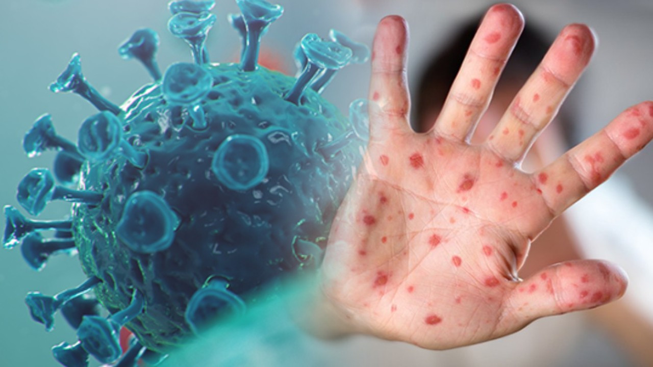 Maymun çiçeği hangi ülkelerde görüldü? Tehlike yayılıyor! Maymun çiçeği nasıl bulaşır?