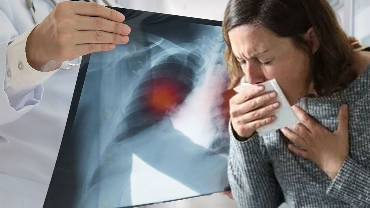 Akciğer kanserinin Türkiye ekonomisine yükü 129 milyar TL