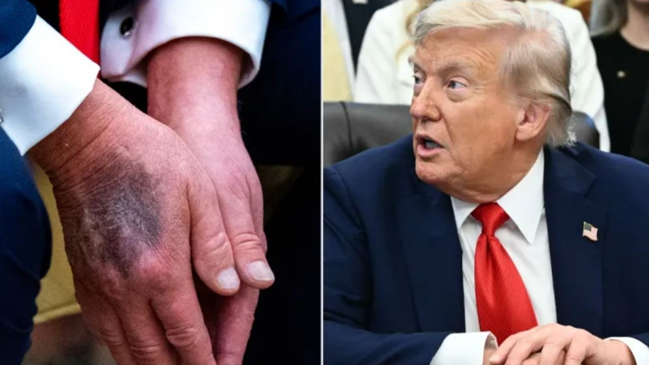 Elinde şişlik ve morluklar oluşmuştu! Trump yine sağlık kontrolüne giriyor