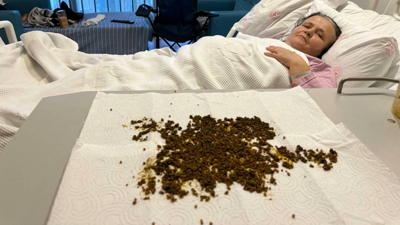 Şiddetli ağrı şikâyetiyle başvuran kadının safra kesesinden 20 binden fazla taş çıkarıldı