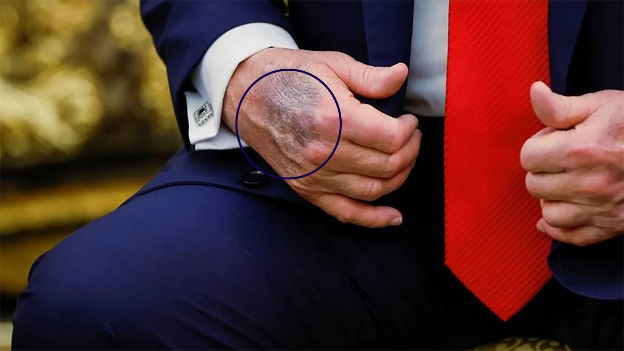 Trump'ın elindeki morlukların nedeni belli oldu