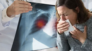 Akciğer kanserinin Türkiye ekonomisine yükü 129 milyar TL