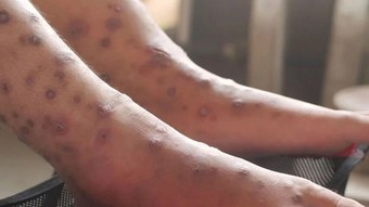 Yeni bir pandemi kapıda mı? Uzmanlar uyardı: Yayılması an meselesi