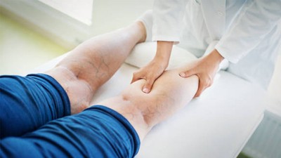 Bacaklarda görülen bu belirtilere dikkat! Varis nedir? Nedenleri ve belirtileri nelerdir?