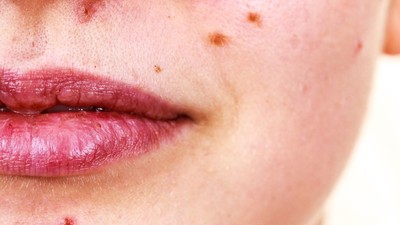 Çığır açan buluş! MRNA teknolojisiyle sivilceye karşı aşı yolda