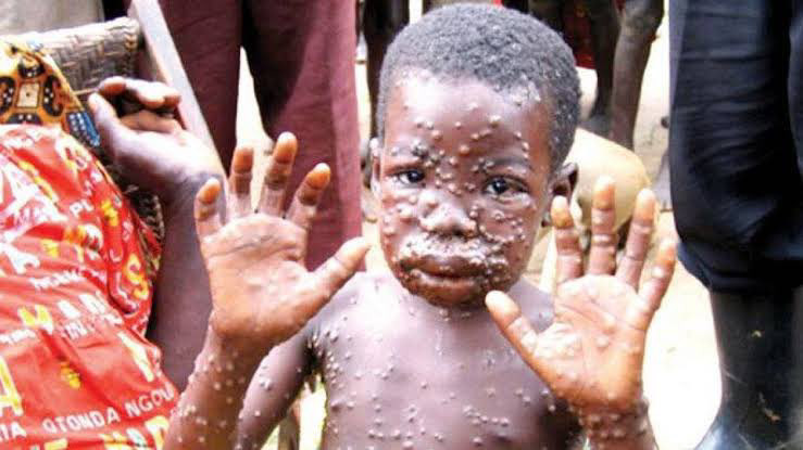 Maymun çiçeği hangi ülkelerde görüldü? Tehlike yayılıyor! Maymun çiçeği nasıl bulaşır? - Resim : 1