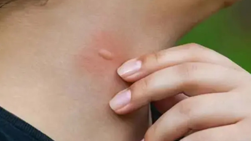 Batı Nil virüsü belirtileri nedir? Türkiye’nin yeni kabusu! Batı Nil virüsü nasıl bulaşır? - Resim : 1