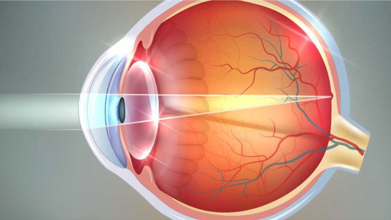 Bu belirtilere dikkat! Astigmat nedir? Astigmat nasıl sınıflandırılır? - Sayfa 1