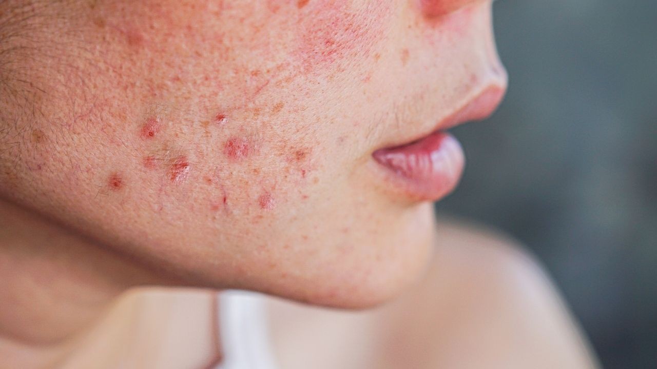 Çığır açan buluş! MRNA teknolojisiyle sivilceye karşı aşı yolda - Sayfa 1