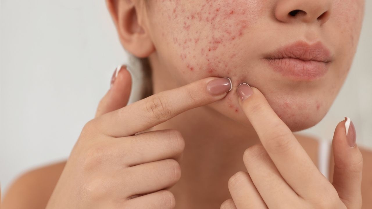 Çığır açan buluş! MRNA teknolojisiyle sivilceye karşı aşı yolda - Sayfa 2