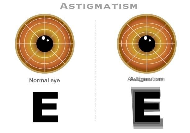 Dünyayı net görün: Astigmatın tanısı ve tedavi yöntemleri! Kesin çözüm nedir? - Sayfa 1