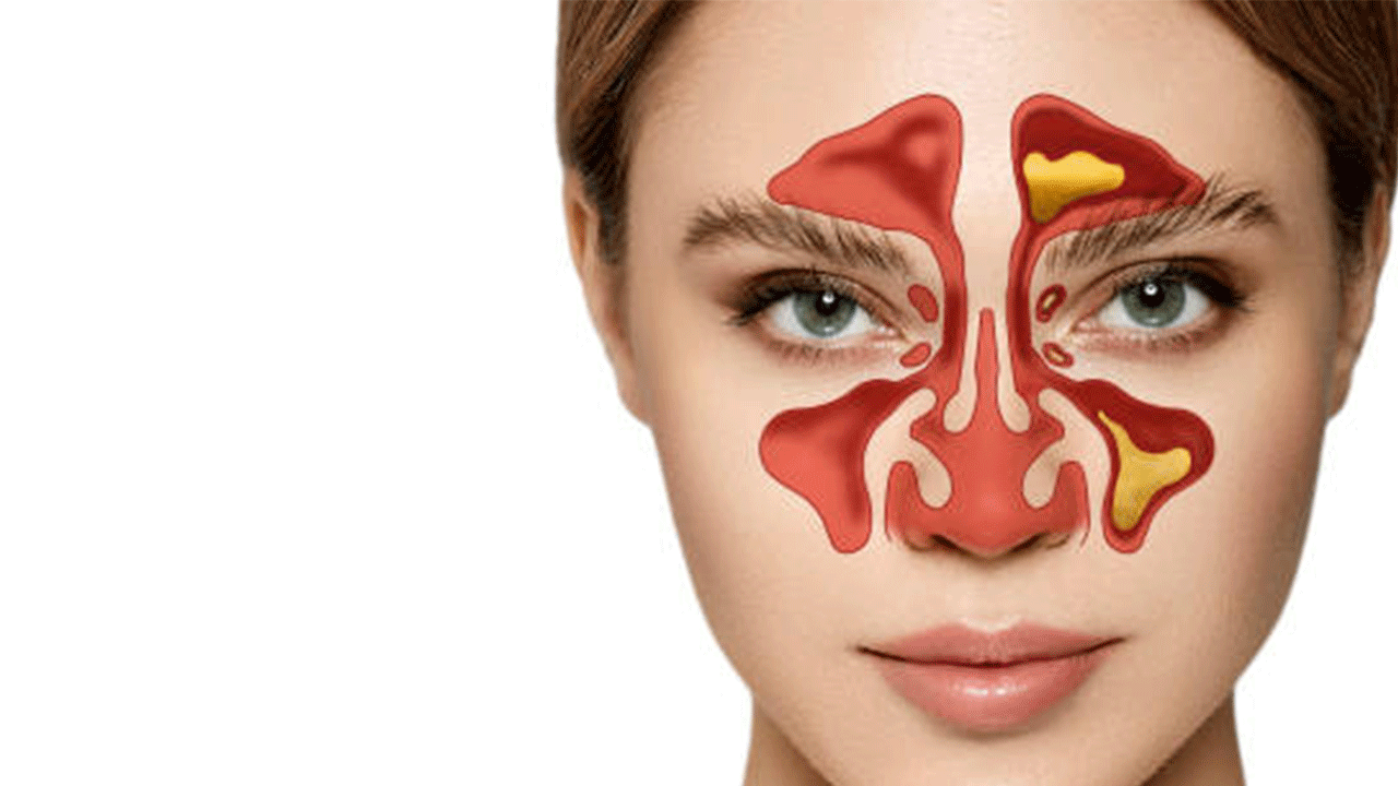 Sinüzit ağrısı nasıl geçer? Sinüzite ne iyi gelir?