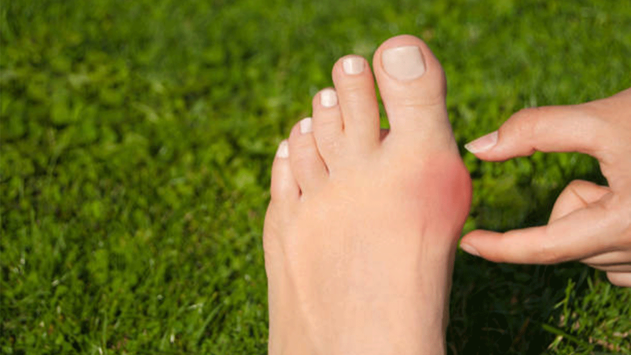 Ayak başparmak kemiği çıkıntısı nasıl geçer? Ameliyatsız çözüm mümkün mü?