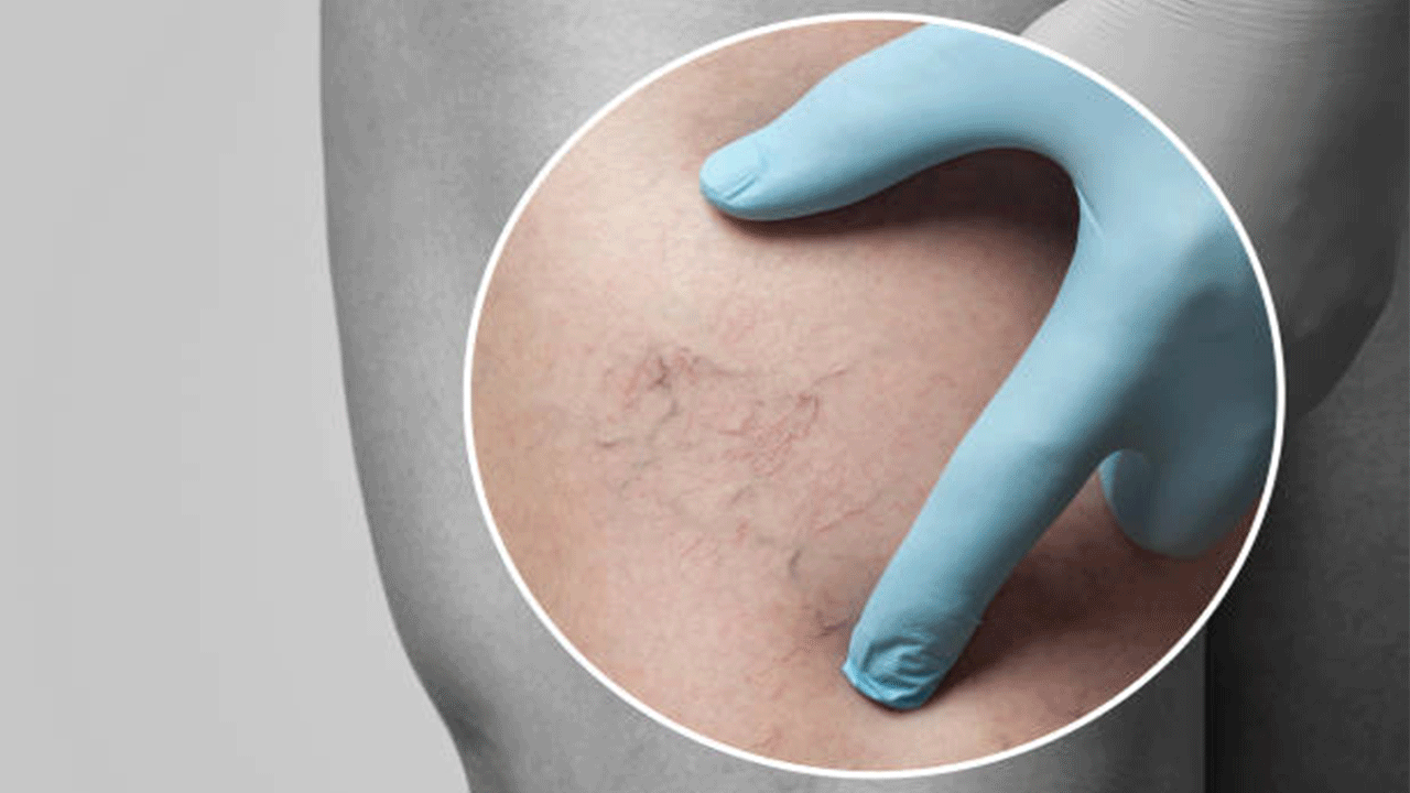 Varis belirtileri nelerdir? Varis nasıl geçer?