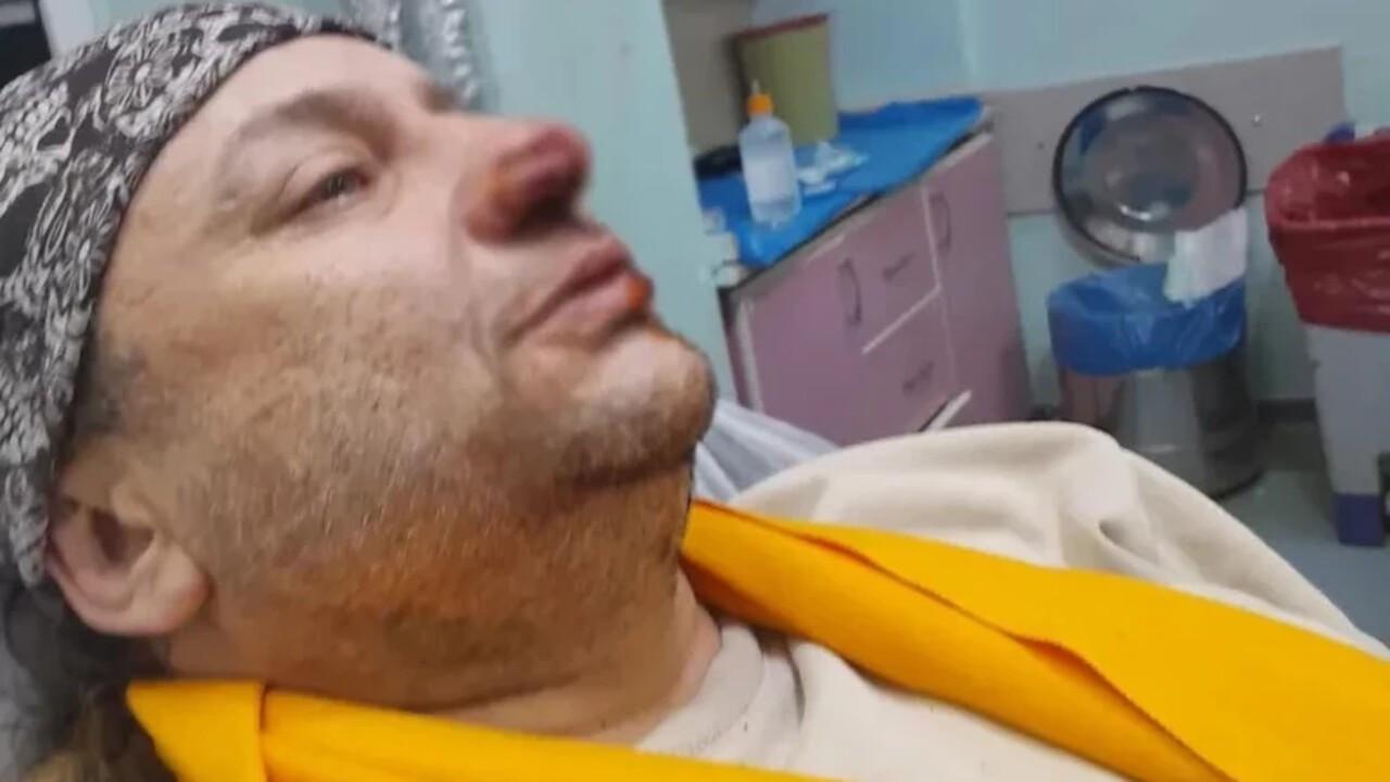 Ünlü isim yürüyüş yaparken pitbul saldırısına uğradı: Burnu parçalandı