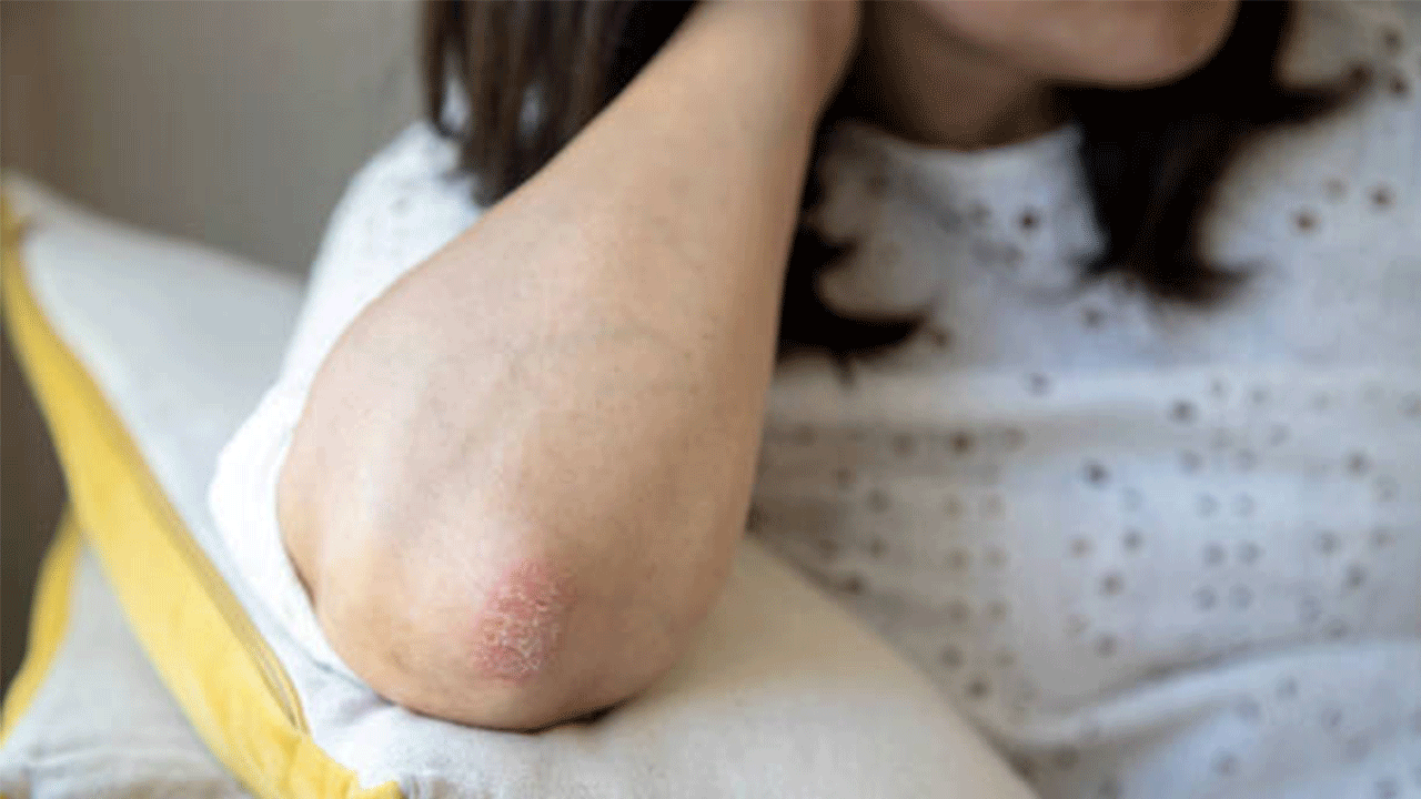 Dirseği sertleşenler dikkat! Meğer sadece kuruluk değil, o hastalıkların habercisiymiş