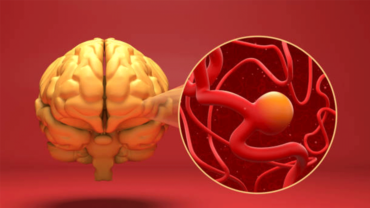 Anevrizma nedir, belirtileri nelerdir ve nasıl tedavi edilir?