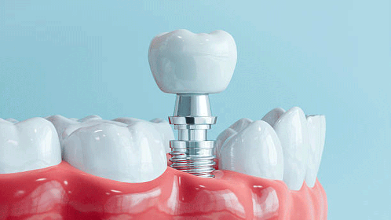 Diş implantı kanser yapar mı: Bilimsel araştırmalar bu iddia için ne diyor?